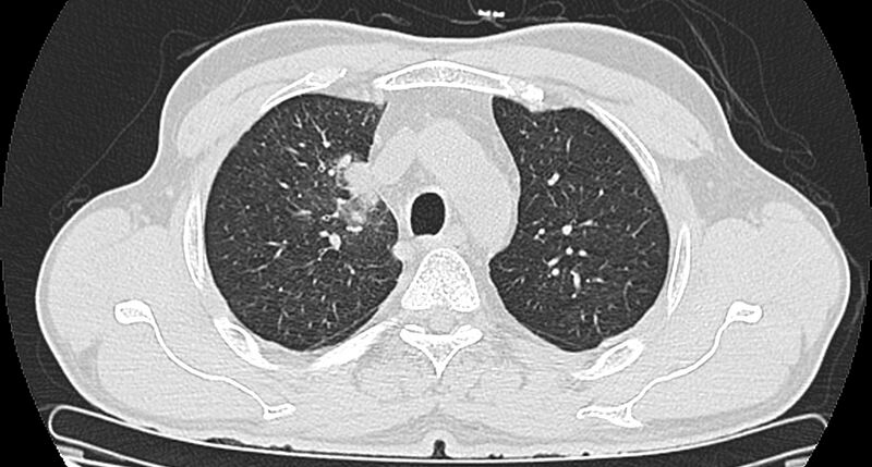 File:Bronchogenic carcinoma with superior vena cava syndrome (Radiopaedia 36497-38054 Axial lung window 29).jpg