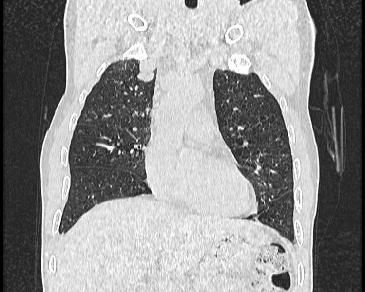 File:Bronchogenic carcinoma with superior vena cava syndrome (Radiopaedia 36497-38054 Coronal lung window 4).jpg