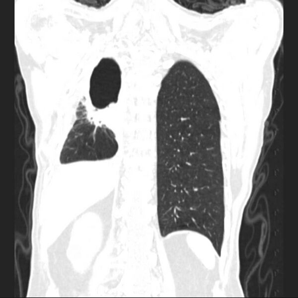 File:Bronchopleural fistula - postoperative complication (Radiopaedia 21020-20947 Coronal lung window 22).jpg