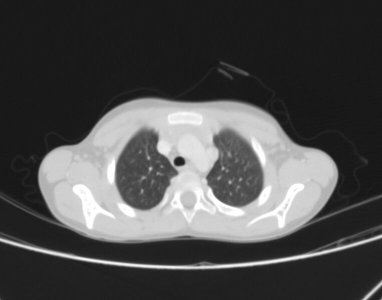File:Bronchus suis (Radiopaedia 68131-77620 Axial lung window 4).jpg