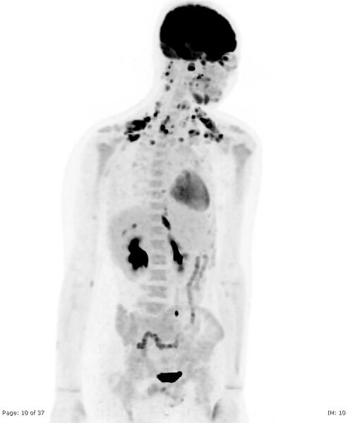 File:Brown fat uptake (FDG PET-CT) (Radiopaedia 77392-89513 MIP 9).jpg