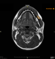 Buccal space- annotated MRI (Radiopaedia 43832).png