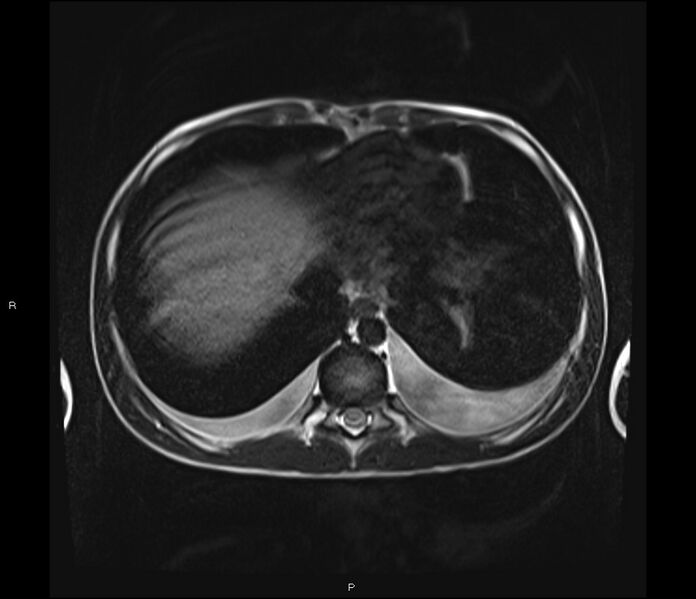 File:Burkitt lymphoma (bowel) (Radiopaedia 68839-78557 Axial T2 7).jpg