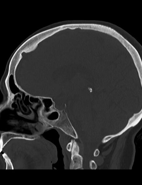 File:Burnt-out meningioma (Radiopaedia 51557-57337 Sagittal bone window 22).jpg
