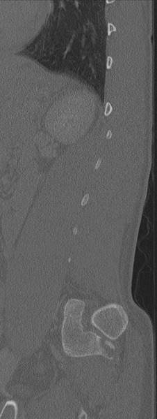 File:Burst fracture - T12 with conus compression (Radiopaedia 56825-63647 Sagittal bone window 16).png