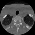 C5 facet fracture (Radiopaedia 58374-65499 Axial bone window 92).jpg
