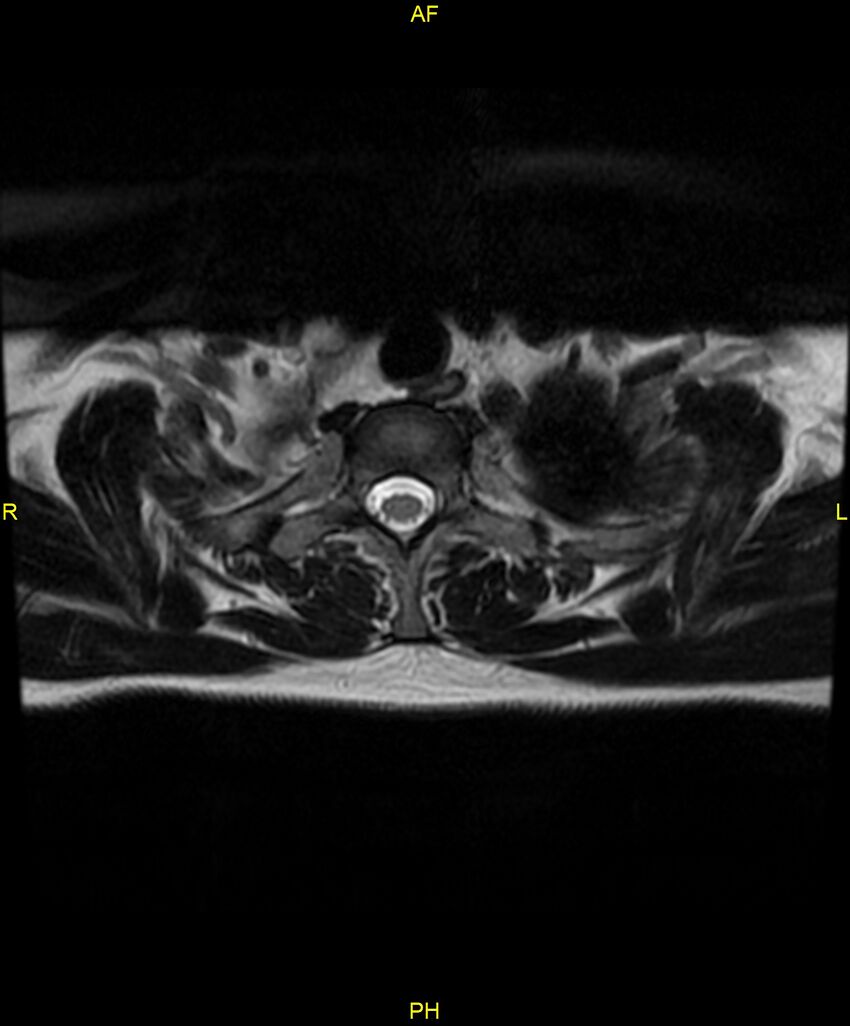C5 nerve sheath tumor (Radiopaedia 85777-101596 Axial T2 88).jpg