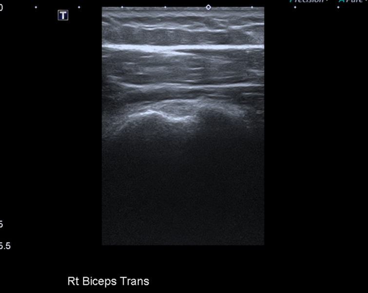 File:Calcific tendinitis (ruptured) (Radiopaedia 56393-63053 A 2).png
