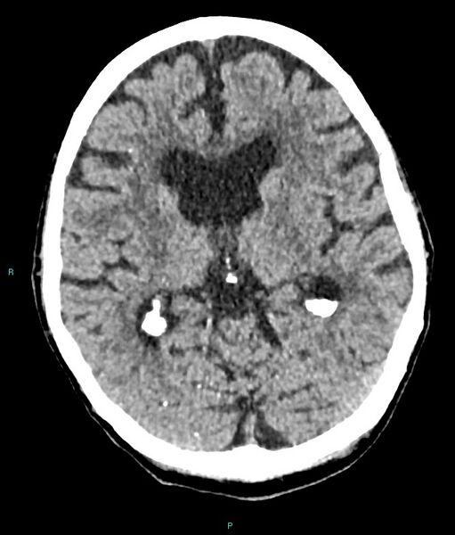 File:Calcified cerebral emboli from left ventricular thrombus (Radiopaedia 84420-99758 Axial non-contrast 49).jpg