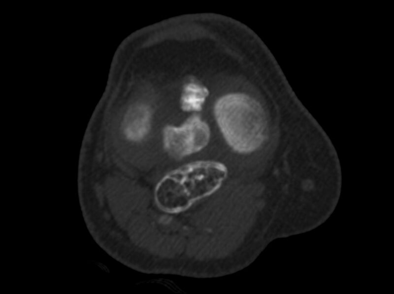 File:Calcified hematoma - popliteal fossa (Radiopaedia 63938-72763 C 22).jpg