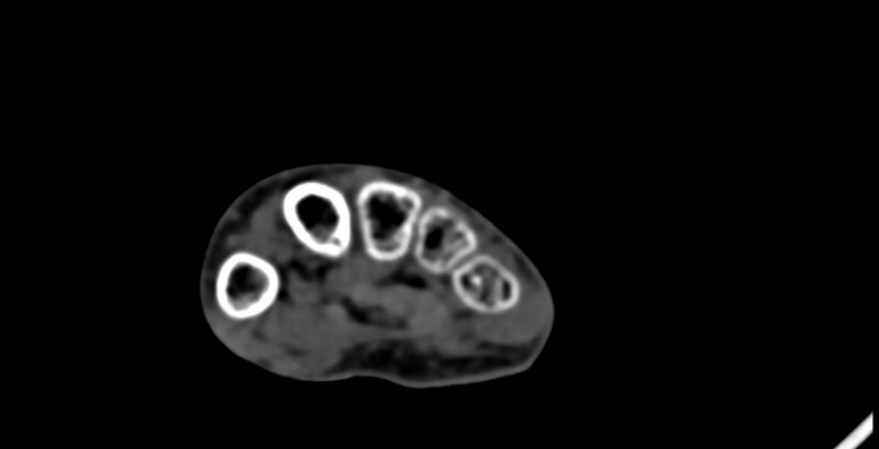 File:Calcifying aponeurotic fibroma (Radiopaedia 88423-105064 B 133).jpg