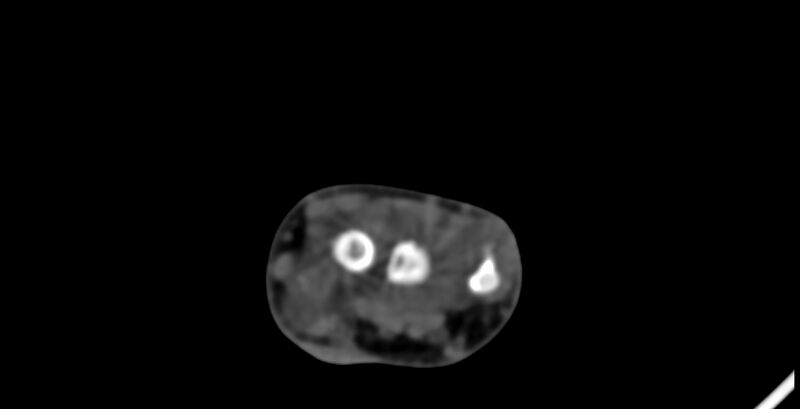 File:Calcifying aponeurotic fibroma (Radiopaedia 88423-105064 B 45).jpg