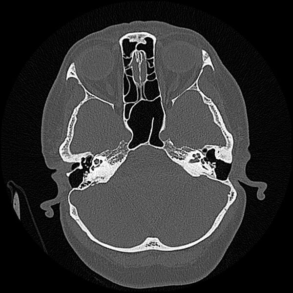 File:Canal up mastoidectomy (Radiopaedia 78108-90638 Axial bone window 73).jpg