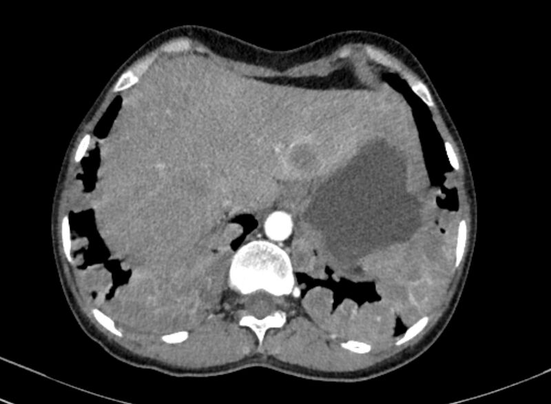 File:Cannonball metastases from breast cancer (Radiopaedia 91024-108569 A 106).jpg