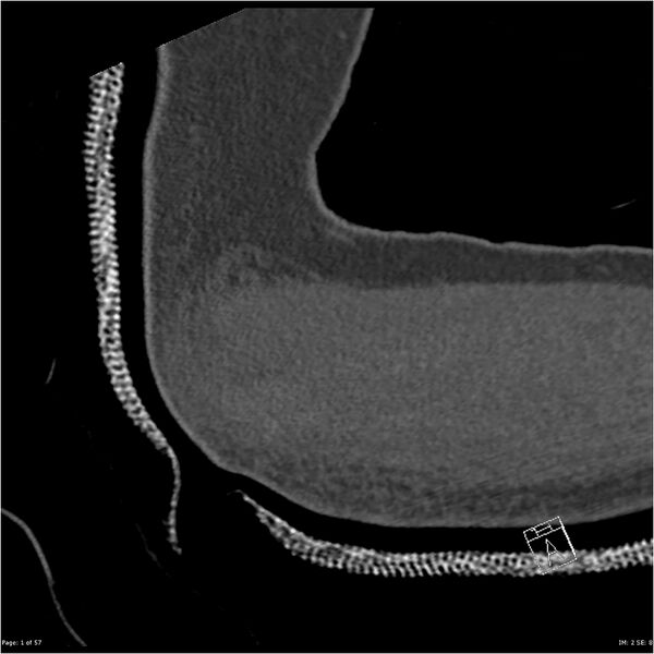 File:Capitellum fracture (Radiopaedia 23352-23426 Sagittal bone window 1).jpg