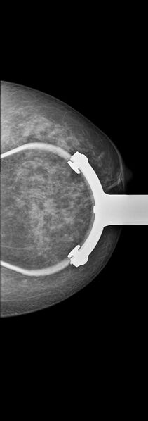 File:Carcinoma of left breast (Radiopaedia 28504-28746 compression 1).jpg