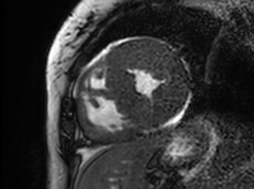 Cardiac amyloidosis (Radiopaedia 61600-69579 Short axis bSSFP 134).jpg