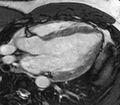 Cardiac sarcoidosis (Radiopaedia 39811-42243 LVOT cine images 26).jpg