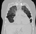Cardiogenic pulmonary edema (Radiopaedia 29213-29609 Coronal lung window 24).jpg