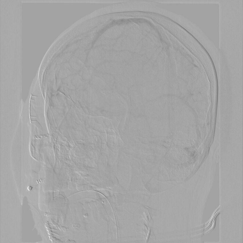 Caroticocavernous fistula - direct (Radiopaedia 61660-69666 Oblique Left ICA 57).jpg