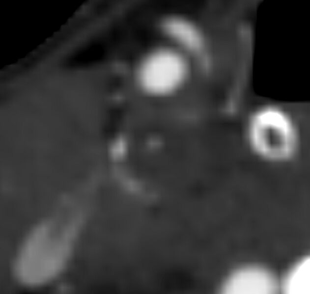 File:Carotid near-occlusion (Radiopaedia 85304-100887 M 46).jpg