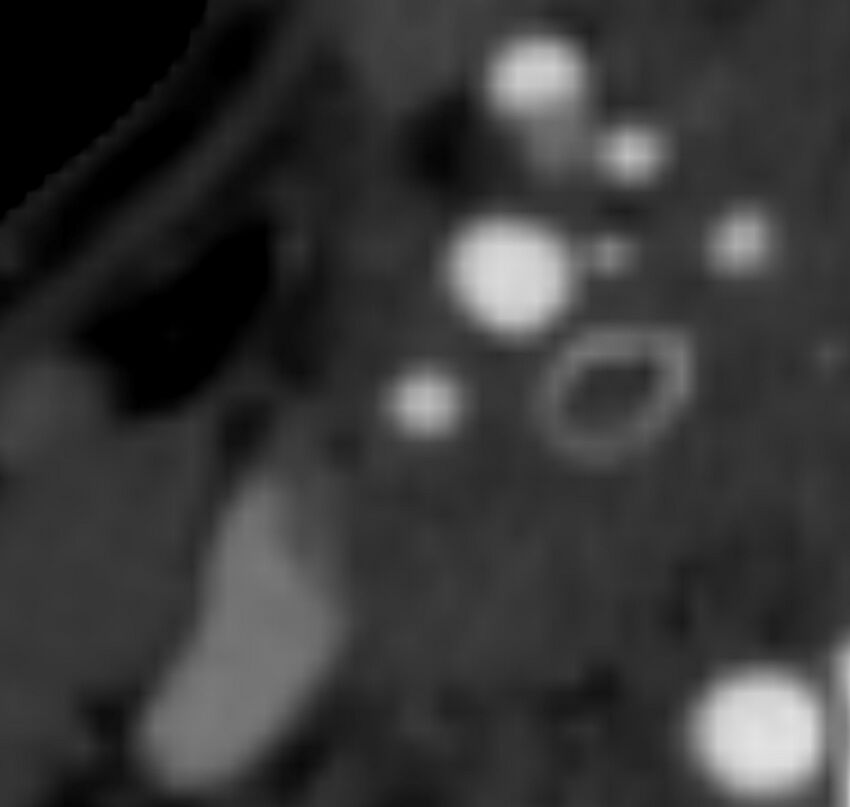 Carotid near-occlusion (Radiopaedia 85304-100887 M 73).jpg