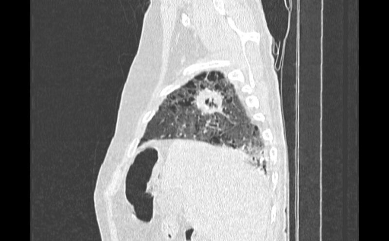 File:Cavitating bronchogenic carcinoma (Radiopaedia 44489-48162 Sagittal lung window 4).jpg