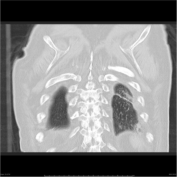 File:Cavitating left lower lobe lesion - squamous cell lung cancer (Radiopaedia 27749-28176 Coronal lung window 50).jpg