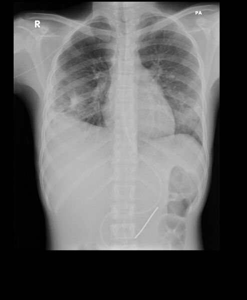 File:Cavitating pneumonia (Radiopaedia 18359).jpg