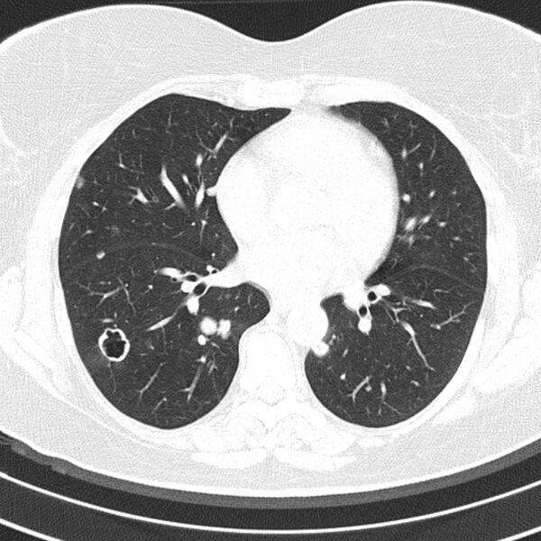 File:Cavitating pulmonary metastases (Radiopaedia 17796-17555 Axial lung window 11).jpg