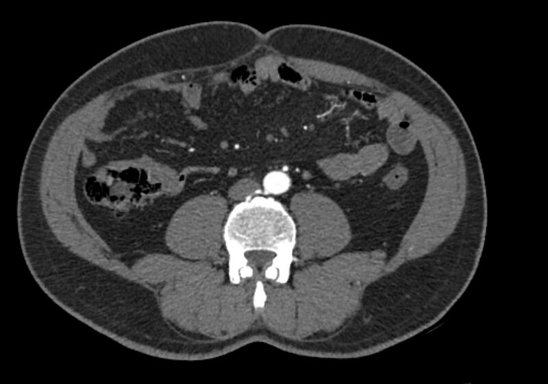 File:Celiac artery dissection (Radiopaedia 52194-58080 A 66).jpg