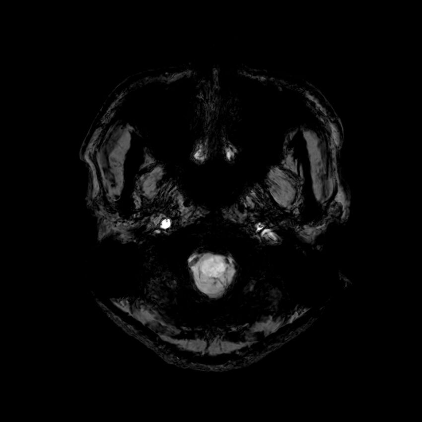 Central neurocytoma (Radiopaedia 79320-92380 Axial SWI 3).jpg