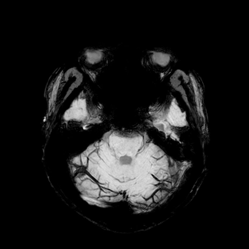 Central neurocytoma (Radiopaedia 79320-92380 Axial SWI 38).jpg