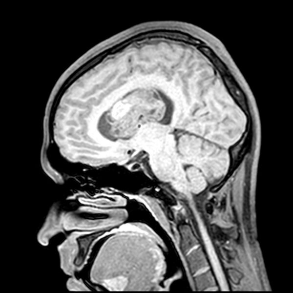 File:Central neurocytoma (Radiopaedia 79320-92380 Sagittal T1 143).jpg
