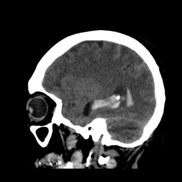 File:Cerebellar hemorrhage causing obstructive hydrocephalus (Radiopaedia 33989-35207 B 15).jpg
