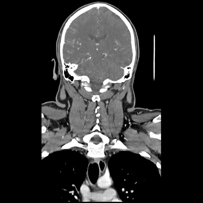 Cerebellar infarct due to vertebral artery dissection with posterior fossa decompression (Radiopaedia 82779-97029 D 39).png