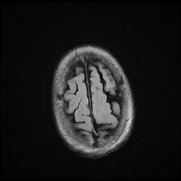 File:Cerebellar metastasis - lung tumor (Radiopaedia 69317-79147 Axial FLAIR 2).jpg