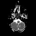 Cerebral abscess post cardiac surgery (Radiopaedia 27244-27420 Axial ADC 4).jpg