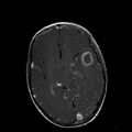 Cerebral abscess post cardiac surgery (Radiopaedia 27244-27420 Axial T1 C+ 9).jpg