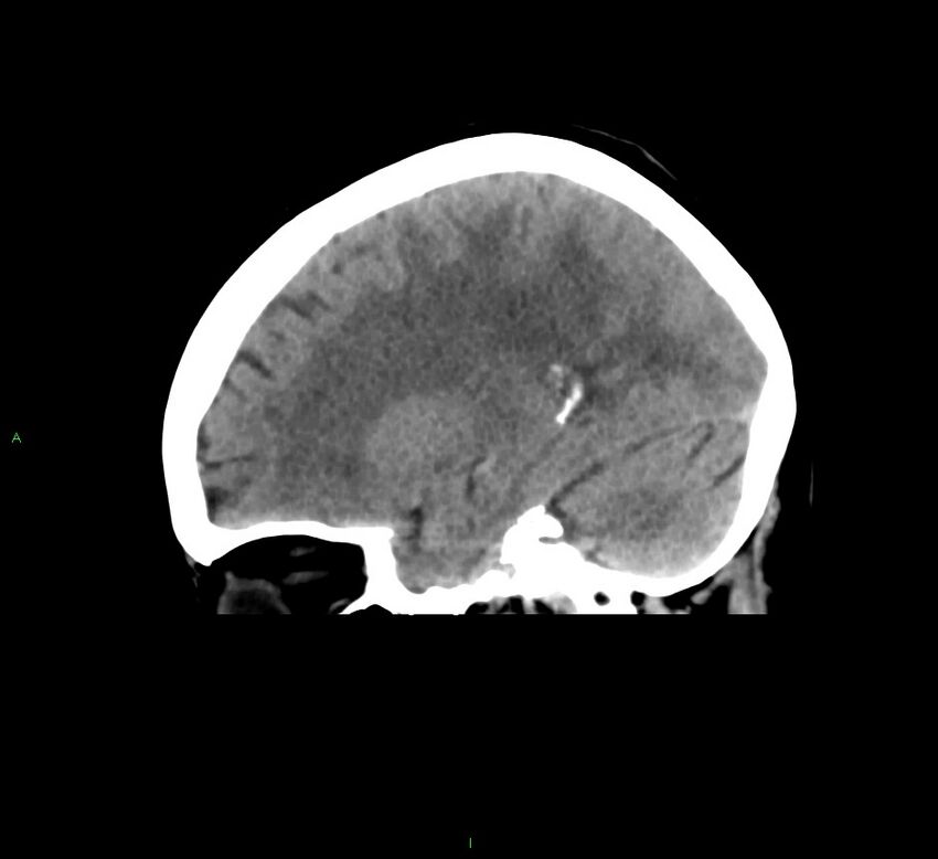 Cerebral amyloid angiopathy-associated lobar intracerebral hemorrhage (Radiopaedia 58378-65516 C 18).jpg