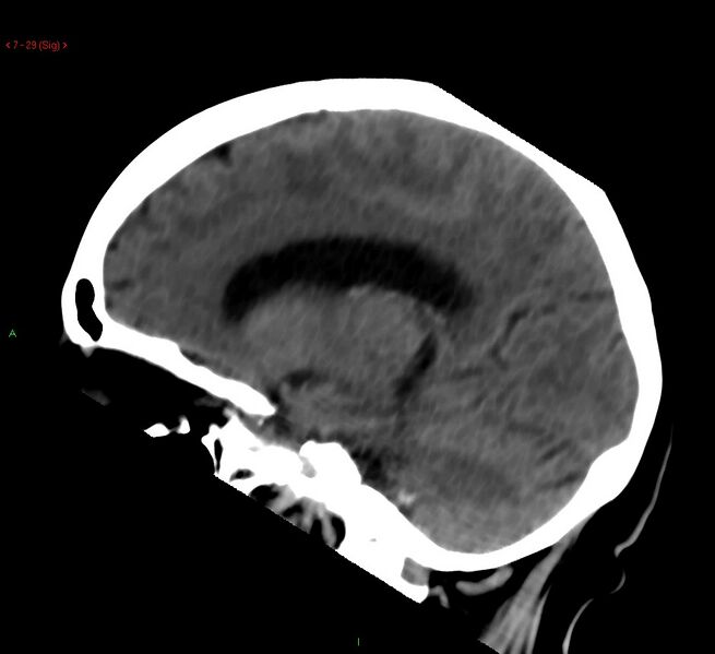 File:Cerebral amyloid angiopathy-associated lobar intracerebral hemorrhage (Radiopaedia 58378-65518 C 29).jpg