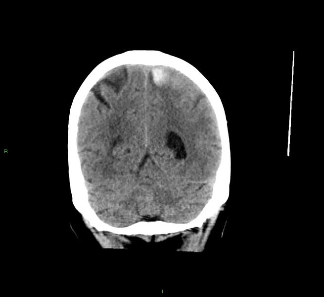 File:Cerebral amyloid angiopathy-associated lobar intracerebral hemorrhage (Radiopaedia 58529-65681 Coronal non-contrast 19).jpg