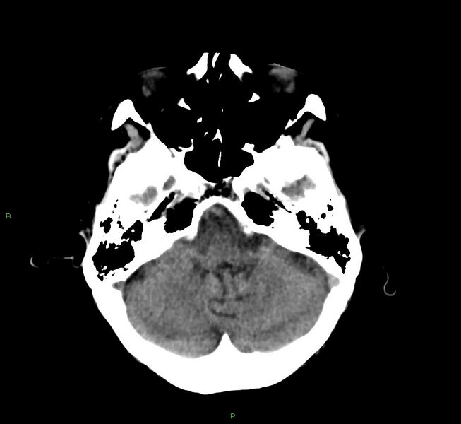 File:Cerebral amyloid angiopathy-associated lobar intracerebral hemorrhage (Radiopaedia 58530-65688 Axial non-contrast 39).jpg