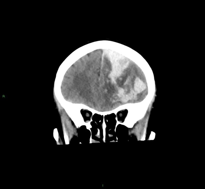 Cerebral amyloid angiopathy-associated lobar intracerebral hemorrhage (Radiopaedia 58561-65724 Coronal non-contrast 46).jpg