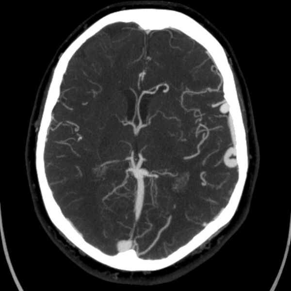 File:Cerebral arteriovenous malformation (Radiopaedia 43729-47189 B 26).jpg