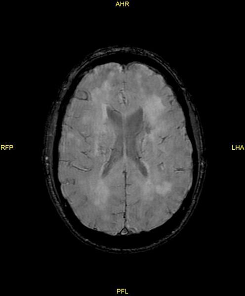 File:Cerebral autosomal dominant arteriopathy with subcortical infarcts and leukoencephalopathy (CADASIL) (Radiopaedia 86108-102054 Axial SWI 67).jpg