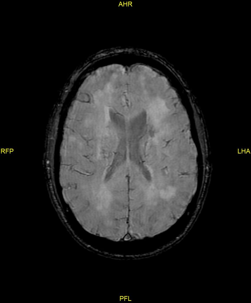 Cerebral autosomal dominant arteriopathy with subcortical infarcts and leukoencephalopathy (CADASIL) (Radiopaedia 86108-102054 Axial SWI 67).jpg