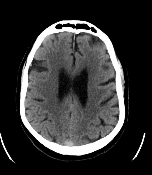 File:Cerebral dural venous sinus thrombosis (Radiopaedia 86514-102575 Axial non-contrast 29).jpg