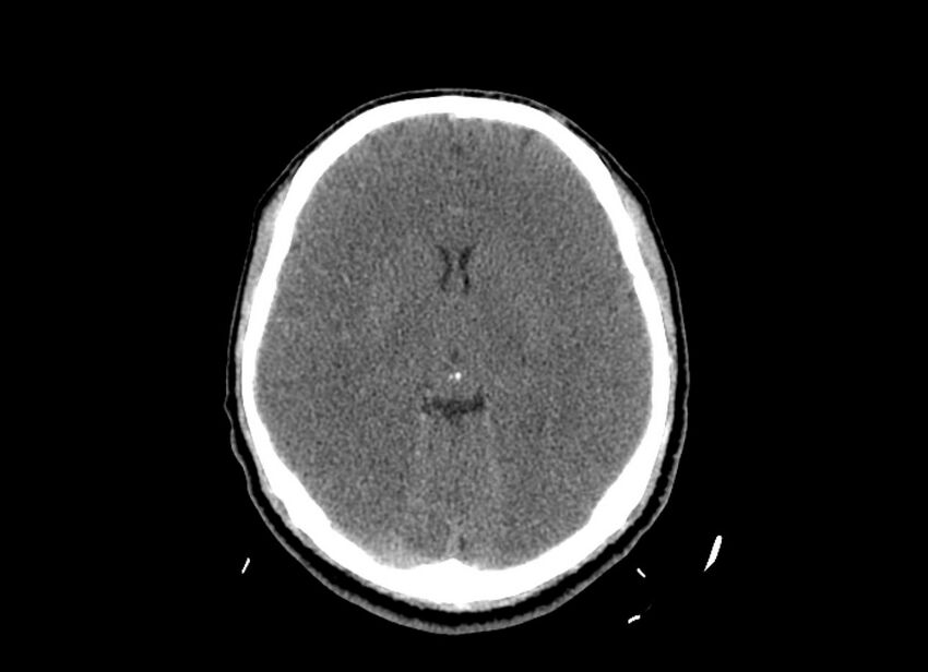 Cerebral edema (Radiopaedia 82519-96661 Axial non-contrast 29).jpg
