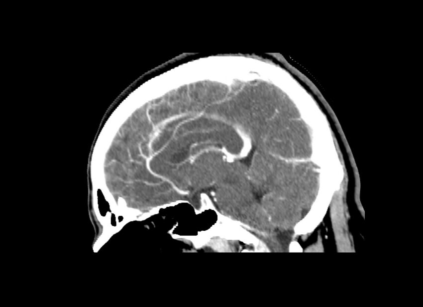 Cerebral edema (Radiopaedia 82519-96661 D 27).jpg